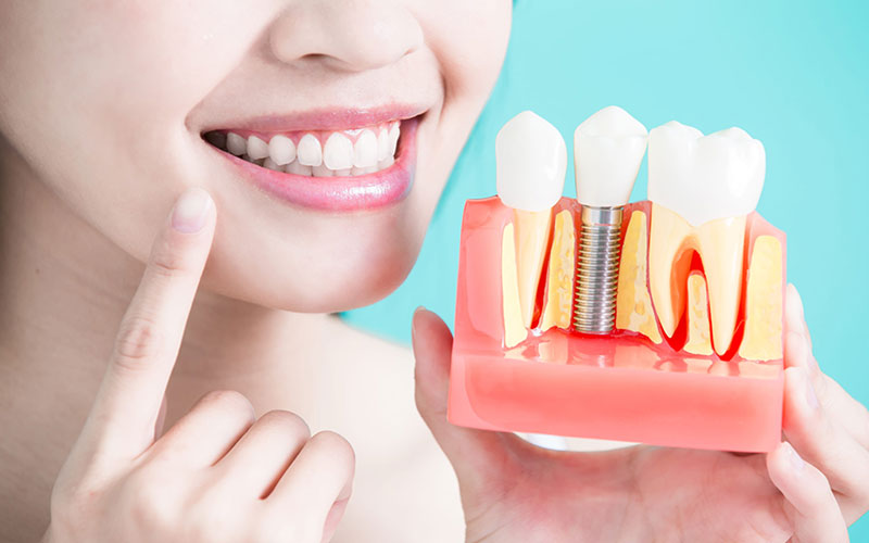Dental Implants: A Permanent Solution for Missing Teeth
